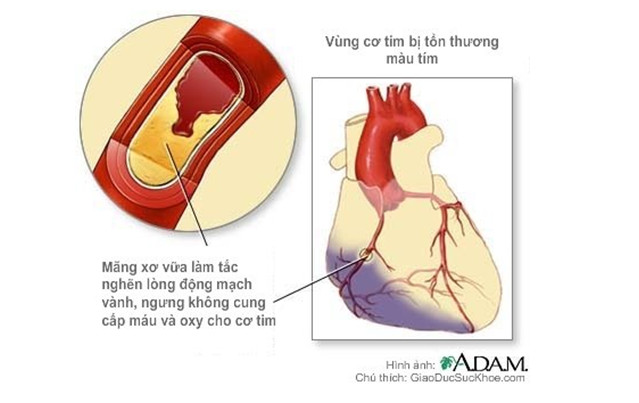 711137 Nhồi máu cơ tim   Nguyên nhân và cách phòng tránh